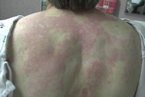 Hives (Urticaria) & Angioedema Symptoms, Diagnosis & Treatment