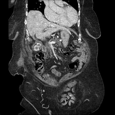 A rare case of gallbladder fistulation with a 60-year-old ...