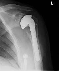 Total Shoulder Arthroplasty - Shoulder & Elbow - Orthobullets