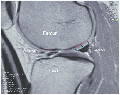 Illustration of the ROIs in the lateral femoral condyle. The femoral... | Download Scientific ...