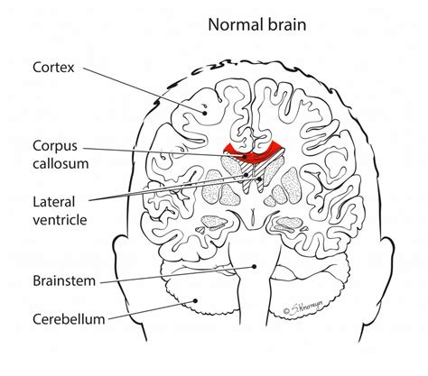 Agenesis of the Corpus Callosum – Ohio Fetal Medicine Collaborative