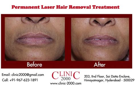 Laser treatment for upperlip hair removal