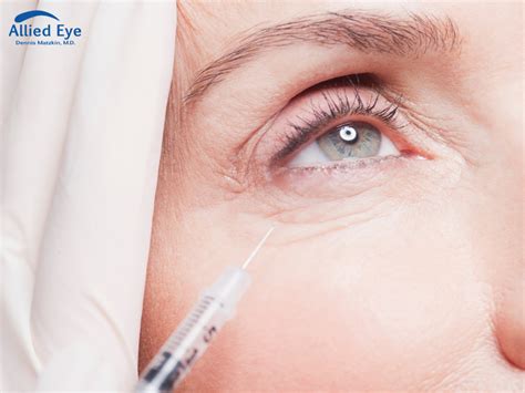 What To Expect During An Eye Injection at Allied Eye