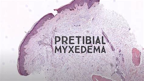 Pretibial Myxedema Graves Disease