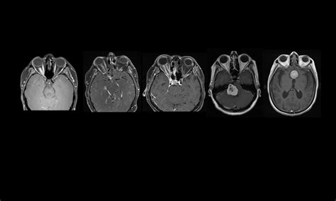 Double vision - Neuro-Ophthalmology