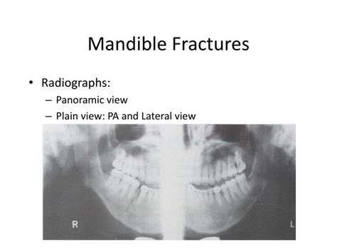 PPT - FRACTURES OF MAXILLA AND MANDIBLE PowerPoint Presentation - ID:2395205