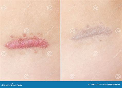 Close Up of Cyanotic Keloid Scar Caused by Surgery and Suturing, Skin Imperfections or Defects ...