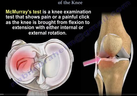 #Knee Evaluation Tests — OrthopaedicPrinciples.com