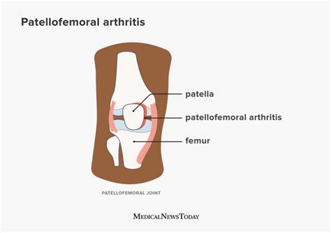 Patellofemoral arthritis: Causes, symptoms, and more