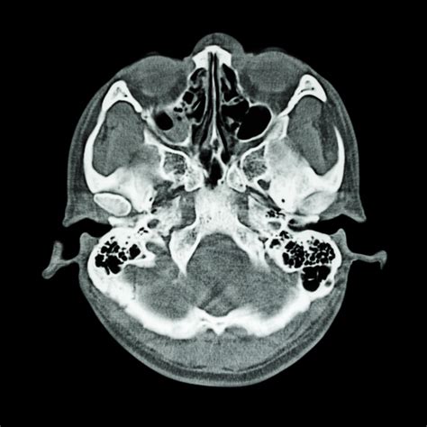 Normal Skull Ct Scan