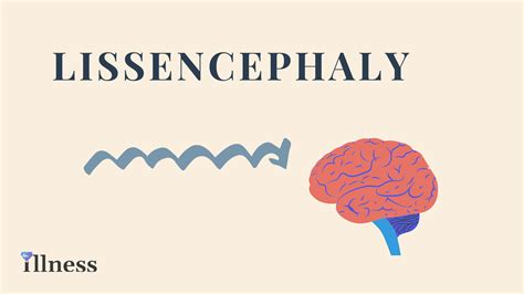 Lissencephaly With Cerebellar Hypoplasia : Overview, Causes, Symptoms, Treatment - illness.com