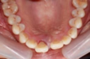Periodontal Disease symptoms are often hidden in smokers, view from above treatment is availablt ...