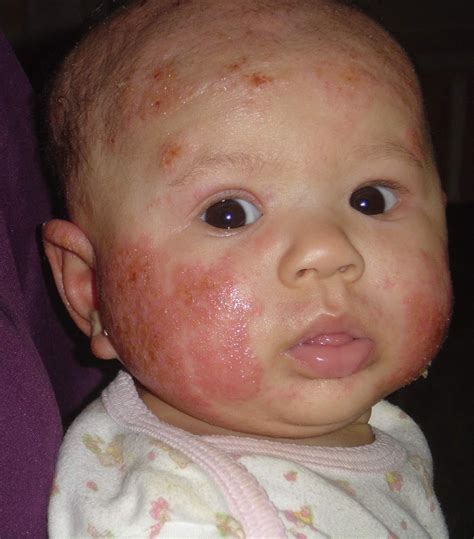 Allergies and neonatal acne baby - Acne Picture