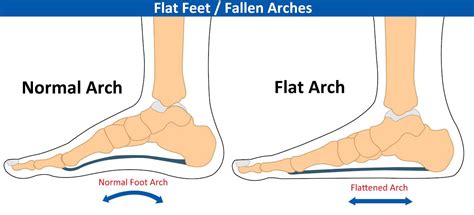 Arch Support for Flat Feet – Footcare Express