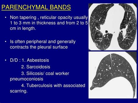 Technical aspect of hrct; normal lung anatomy & hrct findings of lung…