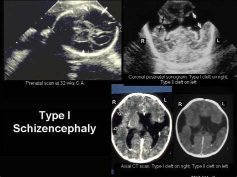 Ultrasound In Schizencephaly (1,2) | Ultrasound, Pediatrics, Medical