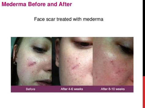 Mederma before-and-after