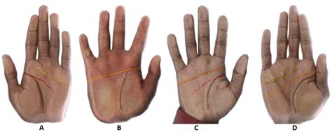 Palm crease types according to the relationship between primary palmar... | Download Scientific ...