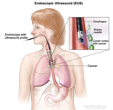 Malignant Mesothelioma Treatment - NCI