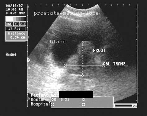 Prostate Anatomy Ultrasound