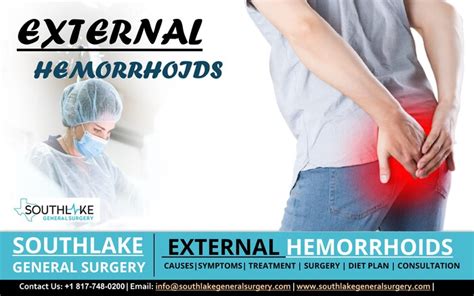 External Hemorrhoids – Symptoms, Treatment, and Surgery - Southlake ...