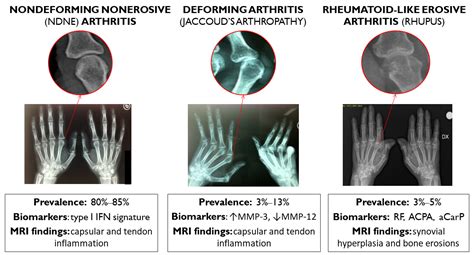 Lupus And Rheumatoid Arthritis Symptoms