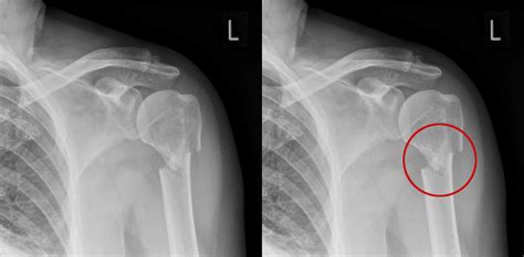 Trauma X-ray - Upper limb gallery 1 - Humerus fractures