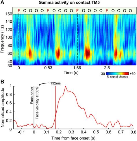 Broadband high frequency (gamma activity) recorded on contact TM5. A.... | Download Scientific ...