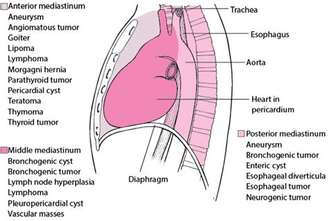 Mediastinal Masses - Pulmonary Disorders - MSD Manual Professional Edition