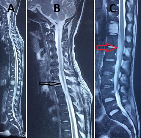 Cureus | Spinal Epidural Abscess in Melioidosis: A Rare Case Report ...