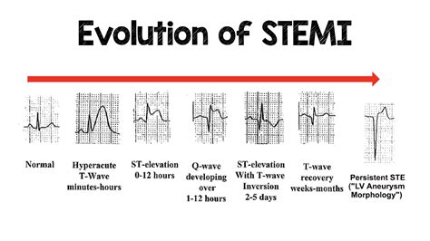 The Evolution of STEMI ECG Changes #STEMI #Evolution ... | GrepMed