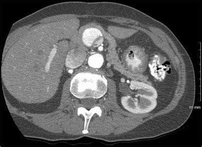 CT of mass abutting the porta hepatis | Download Scientific Diagram