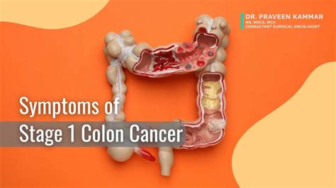 Colorectal Cancer: Symptoms, Causes, And Treatment, 56% OFF