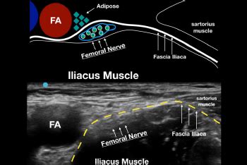 Figure 1: A. Drawing of the relevant sonoanatomy when performing an ultrasound-guided femoral ...