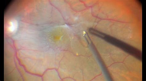 Epi-retinal Membrane removal - YouTube