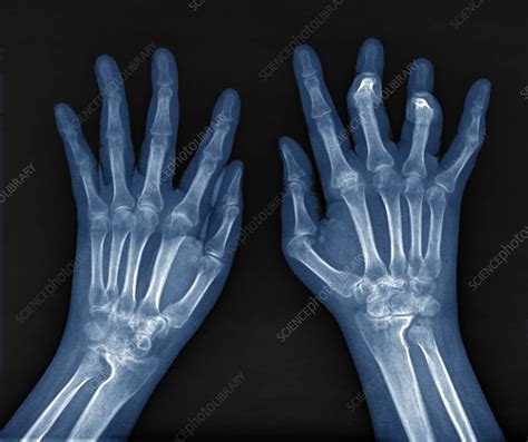 Rheumatoid arthritis of the hands, X-ray - Stock Image - C037/0768 ...