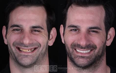 Before and After Periodontal Treatment Photos in Los Angeles