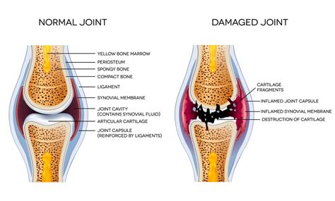 Regenerating Damaged knees: The future has arrived | Arthritis cure, Arthritis treatment ...