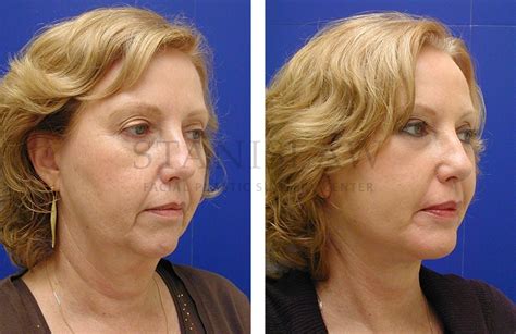 Chin Augmentation Gallery 2 Before and After Photos Connecticut