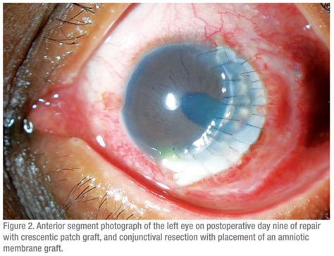 Wills Eye Residents Case Series - Diagnosis and Discussion