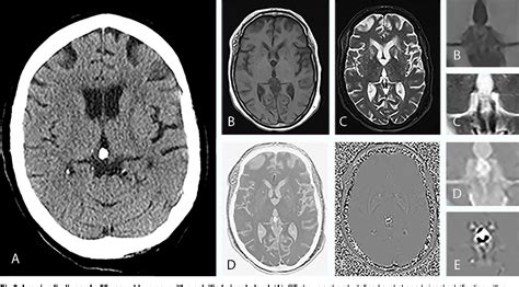 Fig 2. Imaging findings of a 55-year-old woman with a calcified pineal gland. (A), CT shows a ...