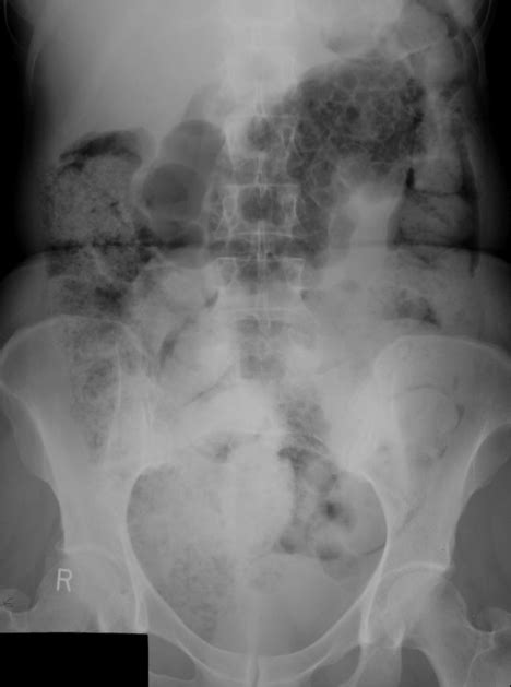 Pneumatosis intestinalis | Radiology Key