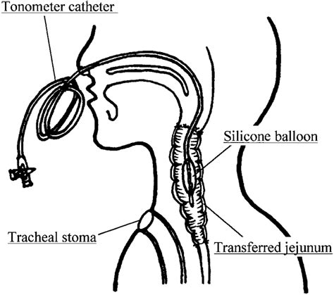 Schema of transnasal insertion of the tonometer catheter. The silicone ...