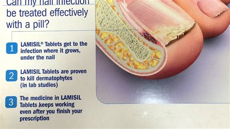 Terbinafine - Side Effects Lamisil - Effect Choices