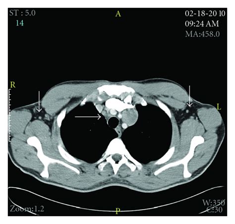 Mediastinal Lymph Nodes Ct Scan