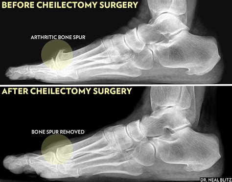 Cheilectomy: Preparation, Recovery, Long-Term Care