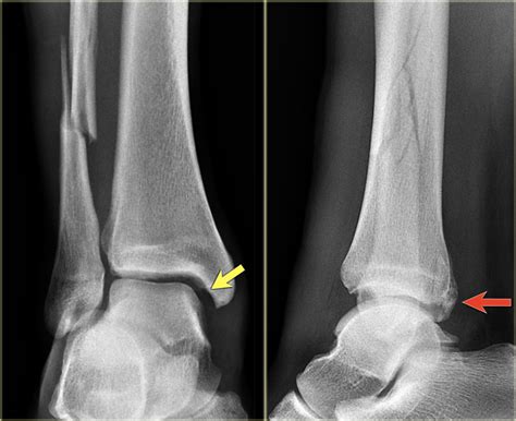 The Radiology Assistant : Ankle fracture - Weber and Lauge-Hansen ...