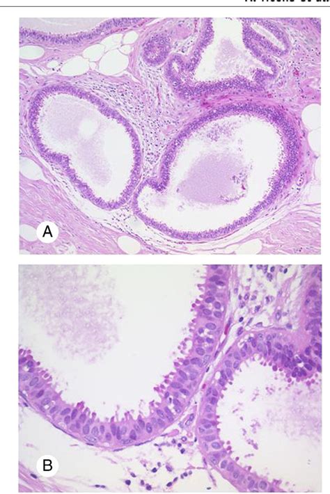 Figure 1 from Flat epithelial atypia is a common subtype of B3 breast lesions and is associated ...