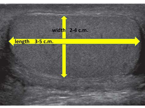 SCROTAL ULTRASOUND