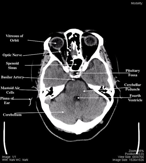 Anatomy Of Brain Ct Scan Anatomy Drawing Diagram Imag - vrogue.co